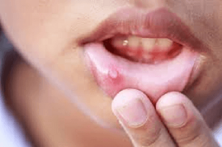 How-to-cure-mouth-ulcers-fast-naturally