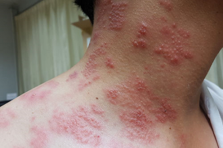 Skin-Rashes