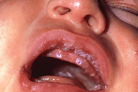 Vaginal-thrush