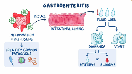 viral-gastroenteritis