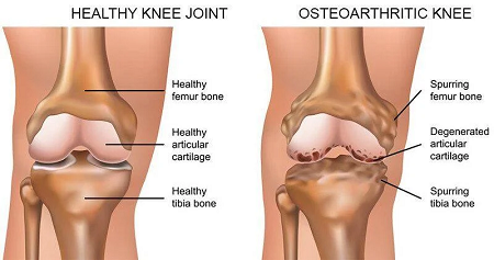 Osteoarthritis-Icd-10