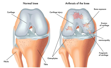 Osteoarthritis